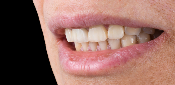 Dental Restoration Options To Replace A Missing Tooth